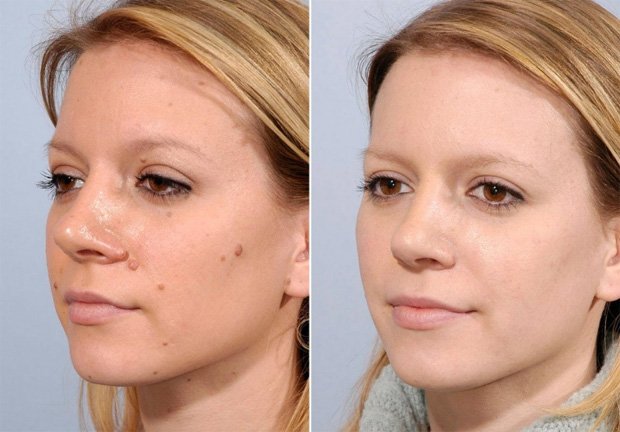 Девушка до и после операции по удалению образований на лице