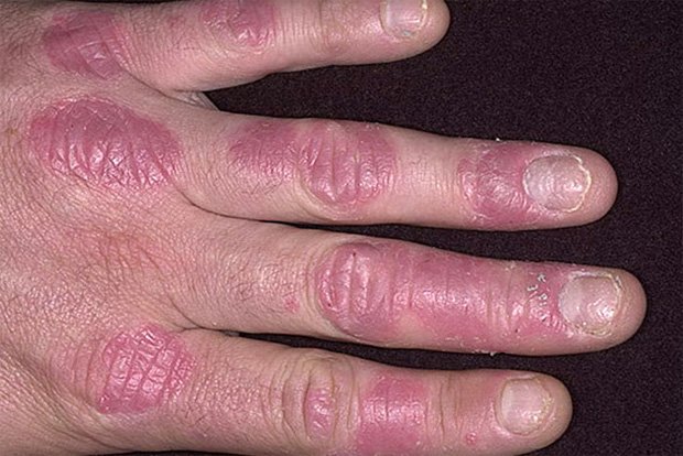 Рука человека, покрытая бляшками псориаза