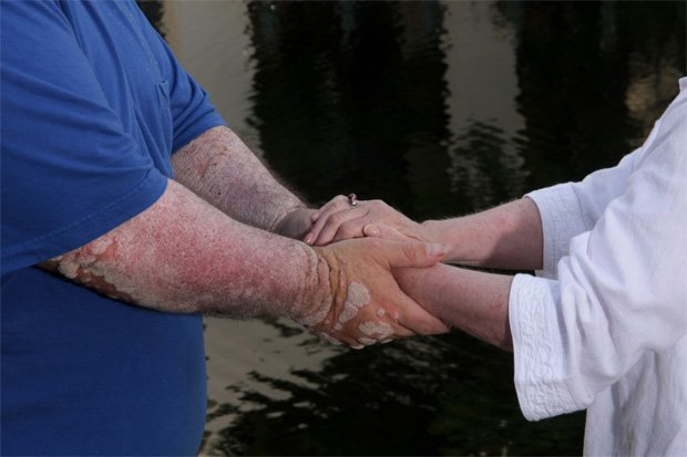 Человек держит за руки больного псориазом человека