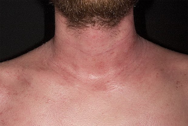 Шея и грудь мужчины с диагнозом атопический дерматит