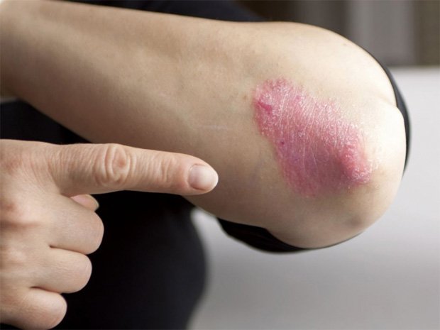 Заболевание кожи псориаз сыпь различные thumbnail