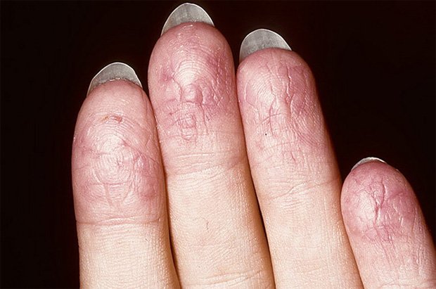 Подушечки пальцев женщины, страдающей псориазом