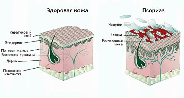 Схематическое изображение здоровой и больной кожи головы