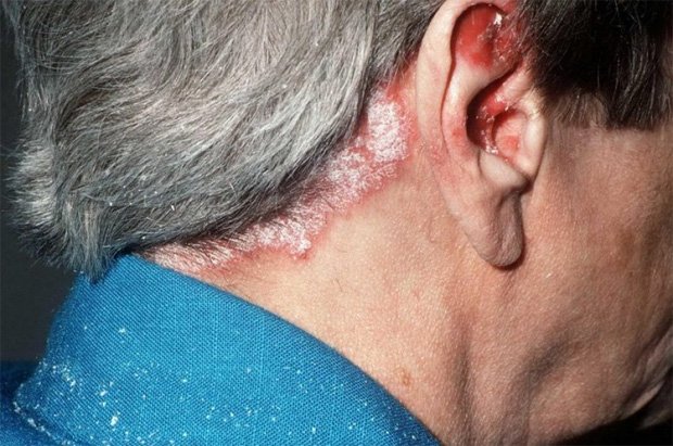 Пожилой мужчина стоит полубоком и показывает заболевание кожи головы