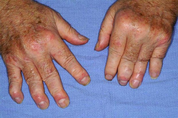 Руки человека, больного псориатическим артритом
