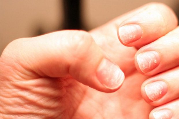 Девушка показывает свои ногти, на которых распространяется болезнь