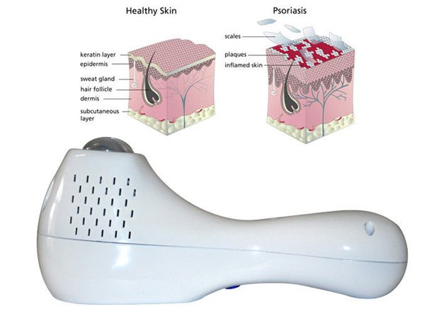Схематическое изображение здоровой и больной кожи и УФ аппарат