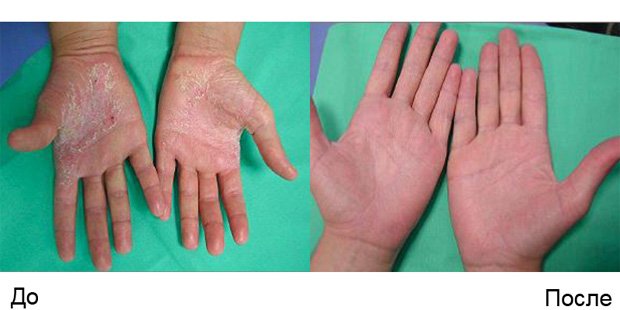 Руки человека с псориазом до и после лечения