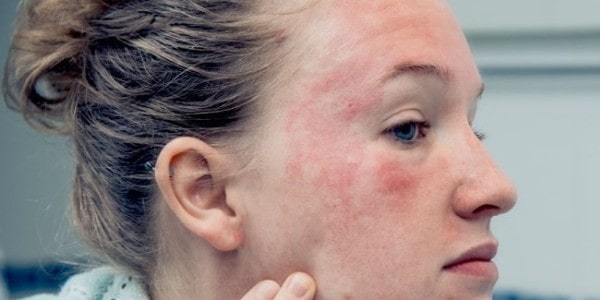 Фото 5. Псориаза на лице у женщины