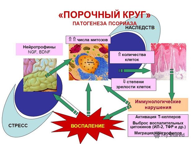 Схематическое определение причины появления патогенеза псориаза