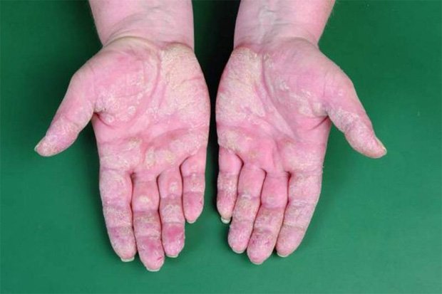 Руки женщины, страдающей от заболевания кожи с высыпаниями