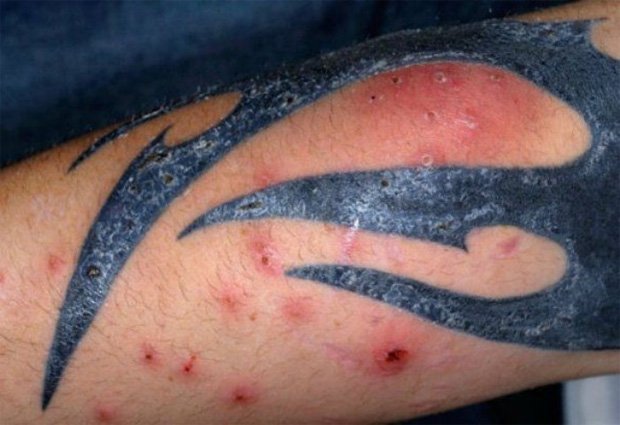 На коже человека с татуировкой болезненные высыпания