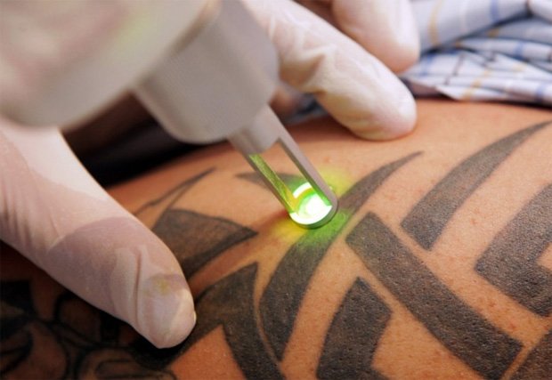 Врач косметолог проводит процедуру лазерного удаления татуировки