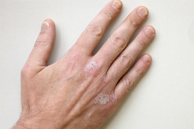 На руке человека небольшая сыпь из-за начальной стадии псориаза