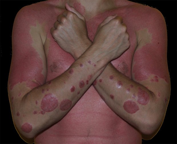 Тело человека, полностью покрытое разными кожными высыпаниями