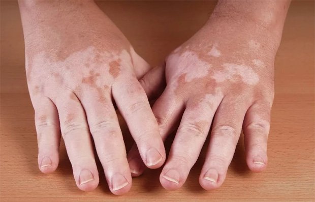 Руки человека с одной из форм рака кожи