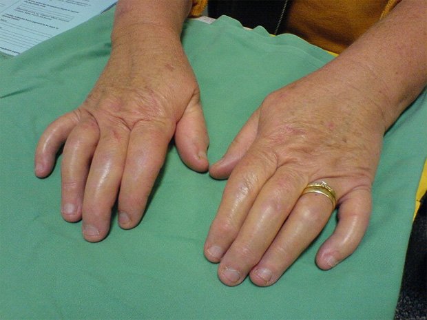 На приеме у врача человек с опухшими от псориаза пальцами рук