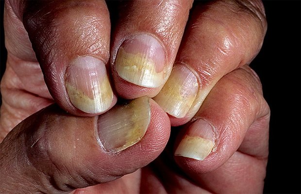 Пожелтевшие ногти больного псориазом