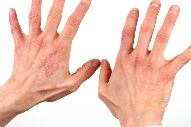 Руки мужчины, который болен псориазом