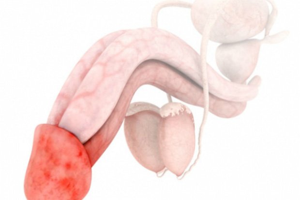 Схематическое изображение воспаленного мужского полового органа
