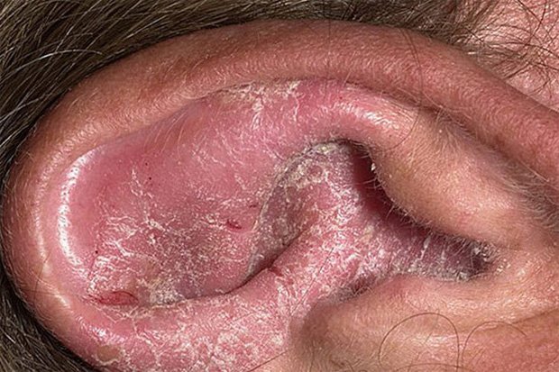 Ушная раковина человека больного псориазом