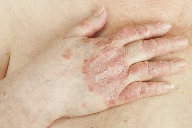 Рука человека с проблемными высыпаниями на коже