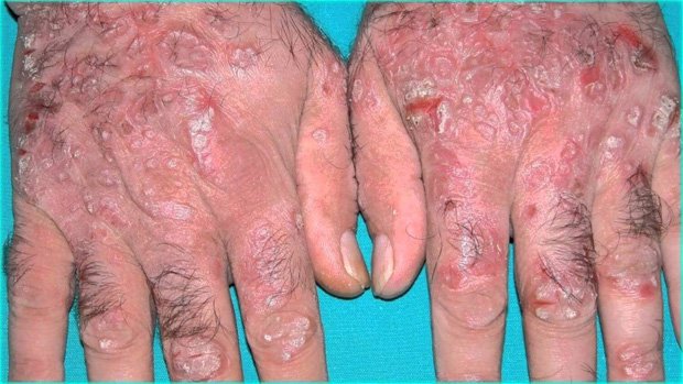 Руки мужчины, покрытые высыпаниями из-за заболевания кожи