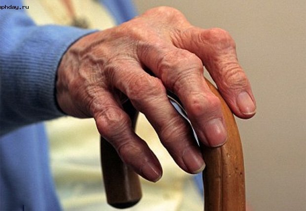 Рука пожилого человека с ревматоидным артритом