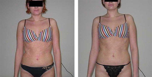 На фото девушка до и после лечения псориаза на своем теле