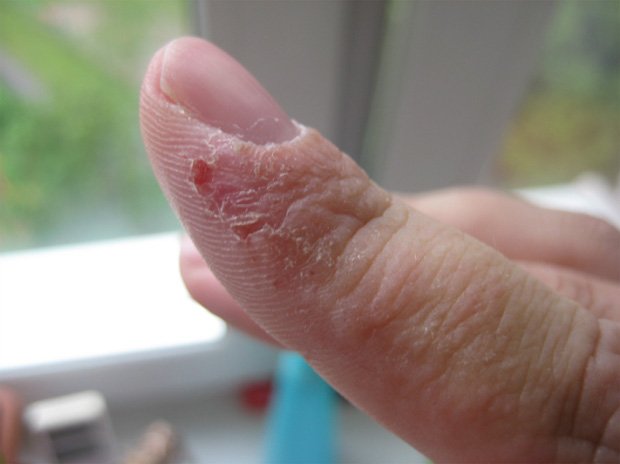 Палец человека, который болен сухой эксземой