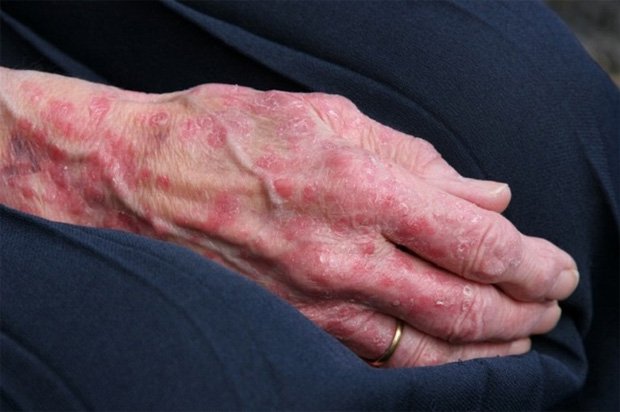 Рука пожилого человека, страдающего нервной эксземой