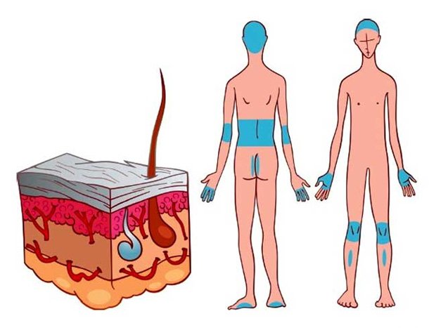 Схематическое изображение уязвимых для псориаза участков кожи